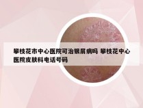 攀枝花市中心医院可治银屑病吗 攀枝花中心医院皮肤科电话号码