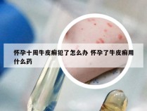 怀孕十周牛皮癣犯了怎么办 怀孕了牛皮癣用什么药