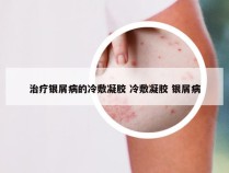 治疗银屑病的冷敷凝胶 冷敷凝胶 银屑病