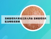 百癣夏塔热片黑龙江济人药业 百癣夏塔热片能治哪些皮肤病