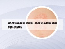 60岁还会得银屑病妈 60岁还会得银屑病妈妈传染吗