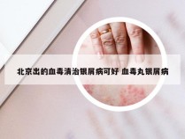 北京出的血毒清治银屑病可好 血毒丸银屑病