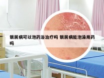 银屑病可以泡药浴治疗吗 银屑病能泡澡用药吗