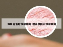 温泉能治疗银屑病吗 泡温泉能治银屑病吗