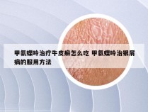 甲氨蝶呤治疗牛皮癣怎么吃 甲氨蝶呤治银屑病的服用方法
