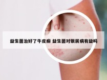 益生菌治好了牛皮癣 益生菌对银屑病有益吗