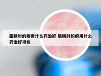 胳膀肘的癣用什么药治好 胳膀肘的癣用什么药治好得快