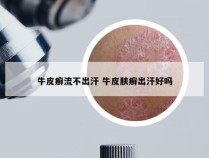 牛皮癣流不出汗 牛皮肤癣出汗好吗