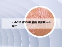 uvb311和308银屑病 银屑病uvb光疗