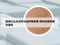 郑州什么方法可以治好银屑病 郑州治银屑病可靠吗