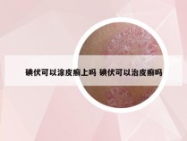 碘伏可以涂皮癣上吗 碘伏可以治皮癣吗