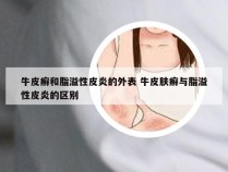 牛皮癣和脂溢性皮炎的外表 牛皮肤癣与脂溢性皮炎的区别