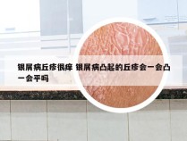 银屑病丘疹很痒 银屑病凸起的丘疹会一会凸一会平吗