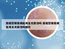 脓疱型银屑病能用足光散泡吗 脓疱型银屑病能用足光散泡吗图片