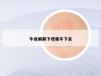 牛皮癣剩下疙瘩不下去