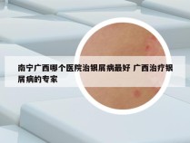 南宁广西哪个医院治银屑病最好 广西治疗银屑病的专家