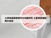小孩有副银屑病可以吃酸奶吗 儿童银屑病能喝牛奶吗