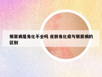 银屑病是角化不全吗 皮肤角化症与银屑病的区别