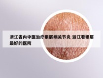 浙江省内中医治疗银屑病关节炎 浙江看银屑最好的医院
