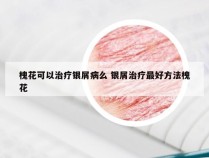 槐花可以治疗银屑病么 银屑治疗最好方法槐花