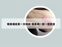 银屑病皮屑一大块掉 银屑病一层一层脱皮