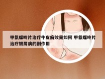 甲氨蝶呤片治疗牛皮癣效果如何 甲氨蝶呤片治疗银屑病的副作用
