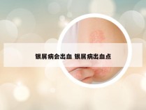 银屑病会出血 银屑病出血点