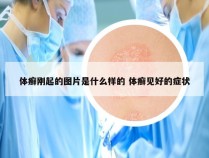 体癣刚起的图片是什么样的 体癣见好的症状