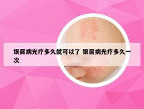 银屑病光疗多久就可以了 银屑病光疗多久一次