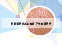 阴部银屑病怎么治疗 下体有银屑病