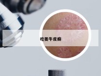 吃姜牛皮癣
