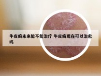 牛皮癣未来能不能治疗 牛皮癣现在可以治愈吗