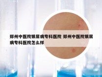 郑州中医院银屑病专科医院 郑州中医院银屑病专科医院怎么样