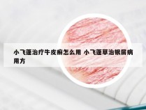 小飞蓬治疗牛皮癣怎么用 小飞蓬草治银屑病用方