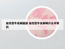 血热型牛皮癣腿部 血热型牛皮癣喝什么中草药