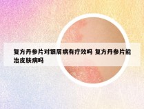 复方丹参片对银屑病有疗效吗 复方丹参片能治皮肤病吗