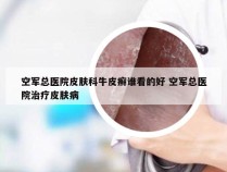 空军总医院皮肤科牛皮癣谁看的好 空军总医院治疗皮肤病