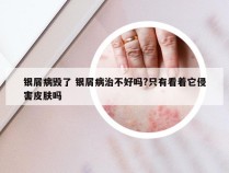 银屑病毁了 银屑病治不好吗?只有看着它侵害皮肤吗
