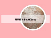 夏天得了牛皮癣怎么办