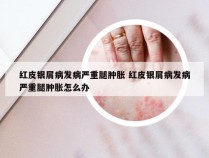 红皮银屑病发病严重腿肿胀 红皮银屑病发病严重腿肿胀怎么办