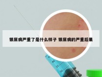 银屑病严重了是什么样子 银屑病的严重后果