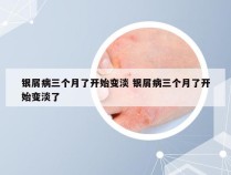 银屑病三个月了开始变淡 银屑病三个月了开始变淡了