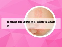 牛皮癣的克星红霉素软膏 银屑病10大特效药