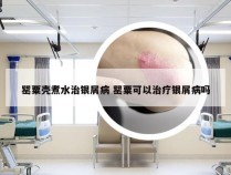 罂粟壳煮水治银屑病 罂粟可以治疗银屑病吗