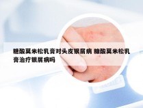 糖酸莫米松乳膏对头皮银屑病 糠酸莫米松乳膏治疗银屑病吗