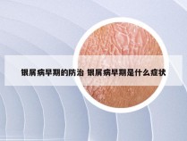 银屑病早期的防治 银屑病早期是什么症状