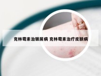 克林霉素治银屑病 克林霉素治疗皮肤病