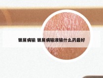 银屑病输 银屑病输液输什么药最好