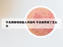 牛皮癣破咯接触人传染吗 牛皮癣弄破了怎么办
