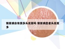 银屑病会有很多头皮屑吗 银屑病患者头皮屑多